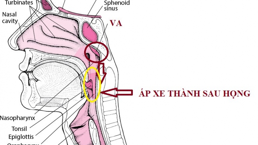 Biến chứng nguy hiểm của viêm VA - áp xe thành sau họng